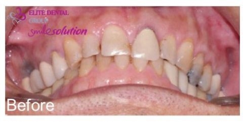 Patient's teeth before porcelain crown treatment