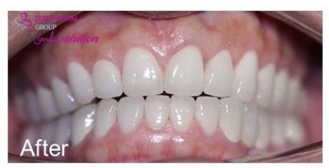 Patient's teeth after porcelain crown treatment
