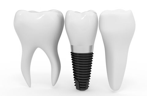 Implants and other kinds of prosthesis