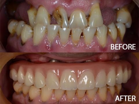 Patient's teeth before and after treatment